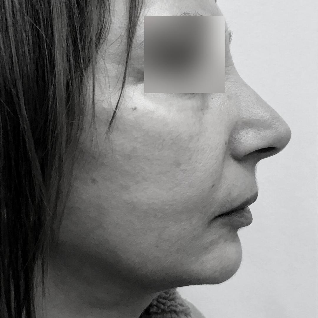 Galleries - Face lifting 12B 1