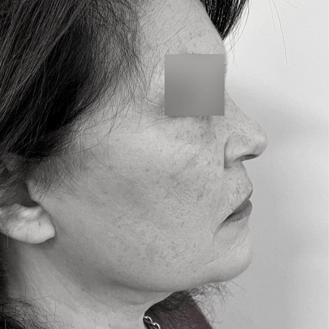 Galleries - Face lifting 20B 1