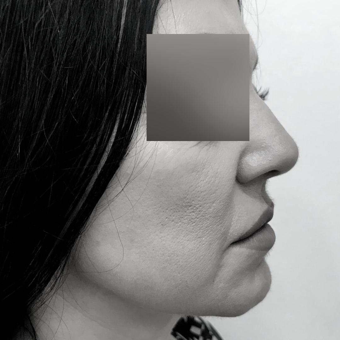 Galleries - Face lifting 5B 1