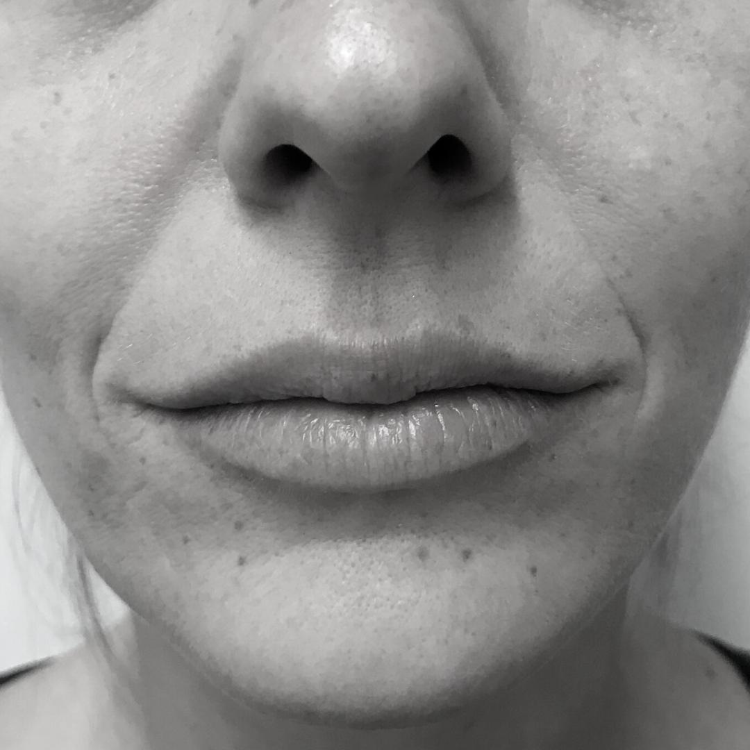 Galleries - Lip lift 1A