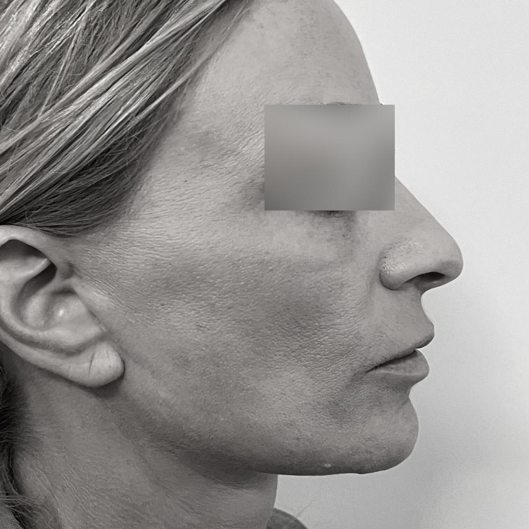 Galleries - Face lifting 29F