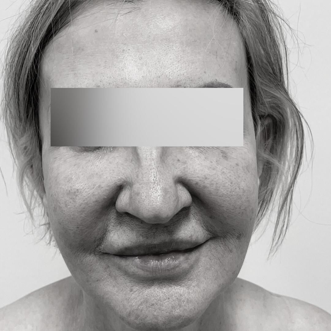 Galleries - Face lifting 30A