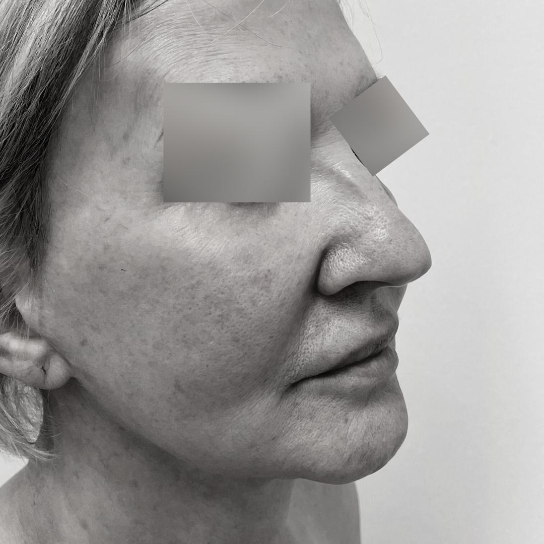 Galleries - Face lifting 30C