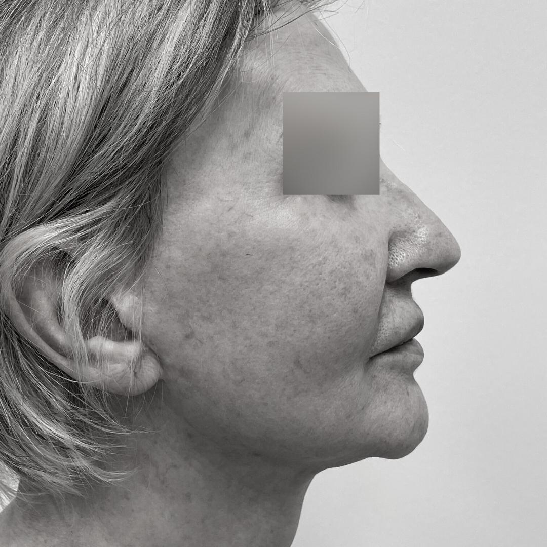 Galleries - Face lifting 30E