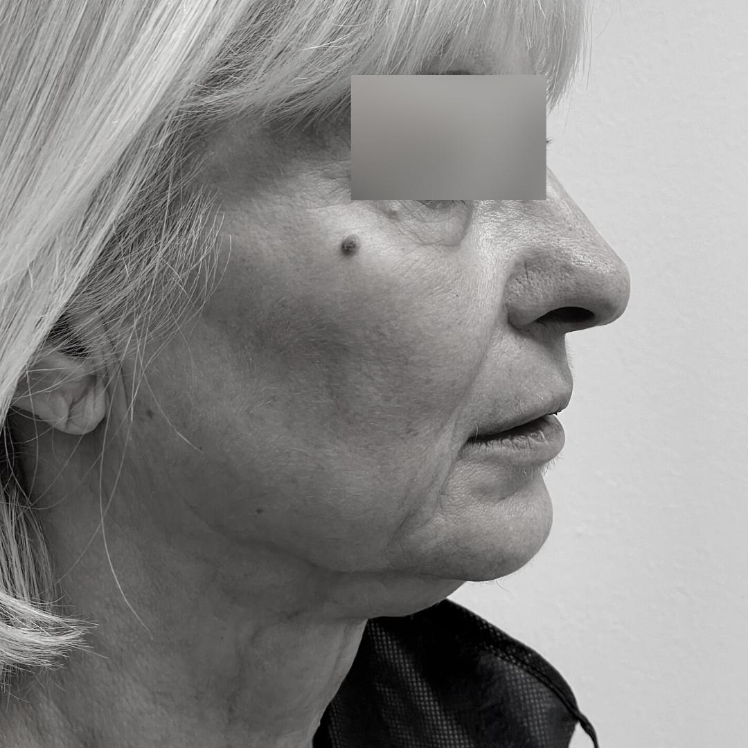 Galleries - Face lifting 31C