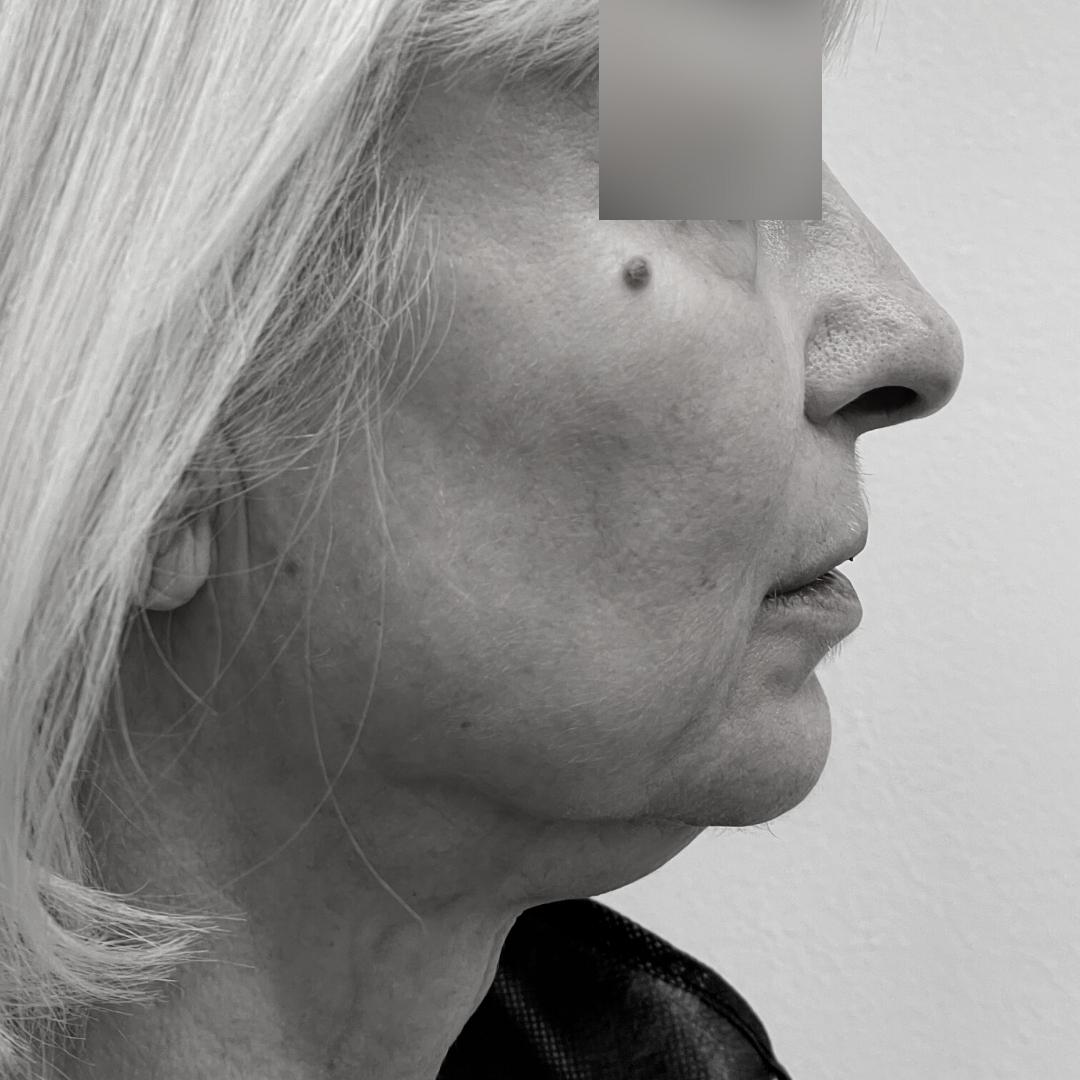 Galleries - Face lifting 31E