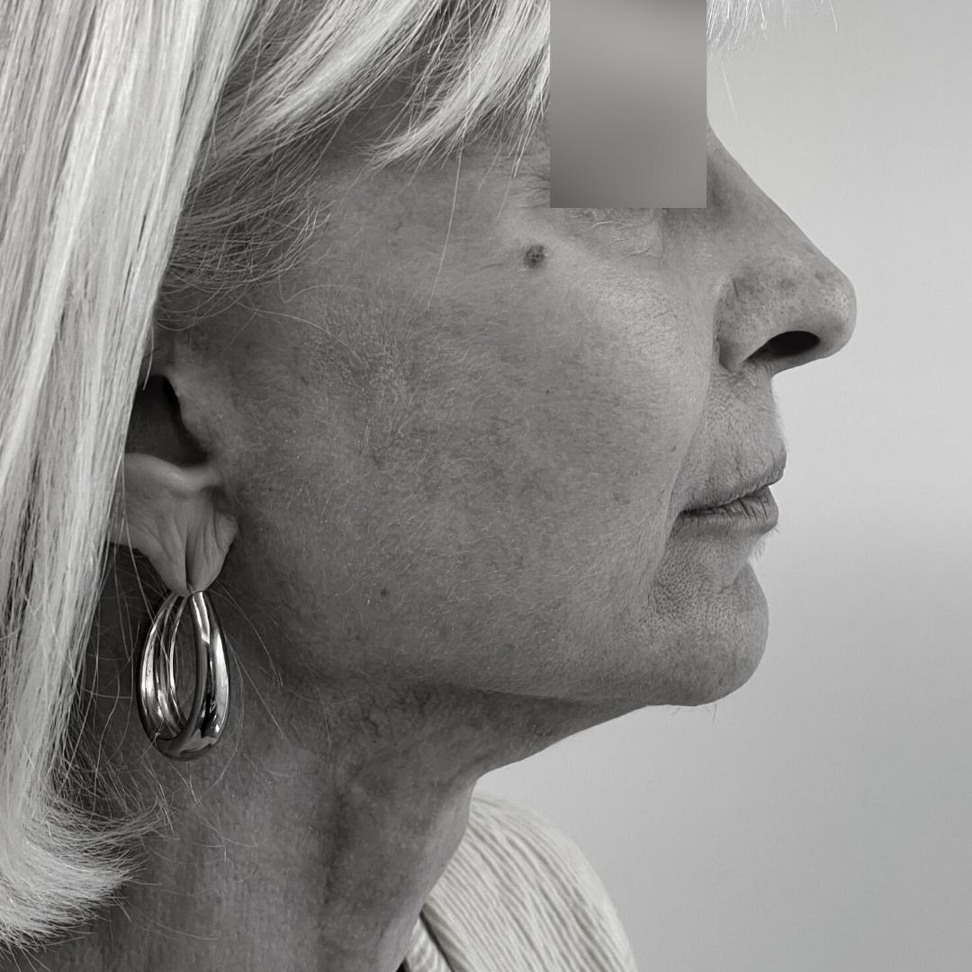 Galleries - Face lifting 31F