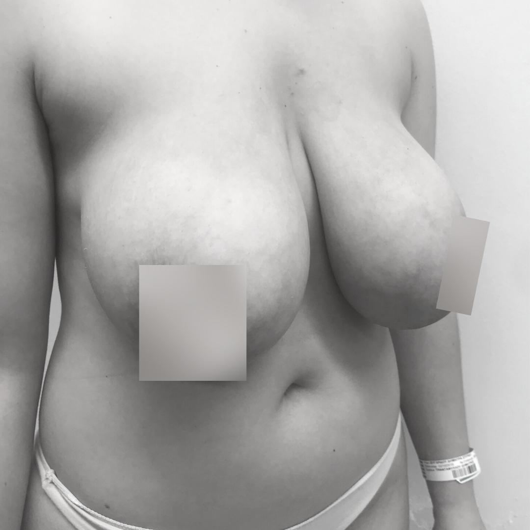 Στήθος - Ανόρθωση 10Α