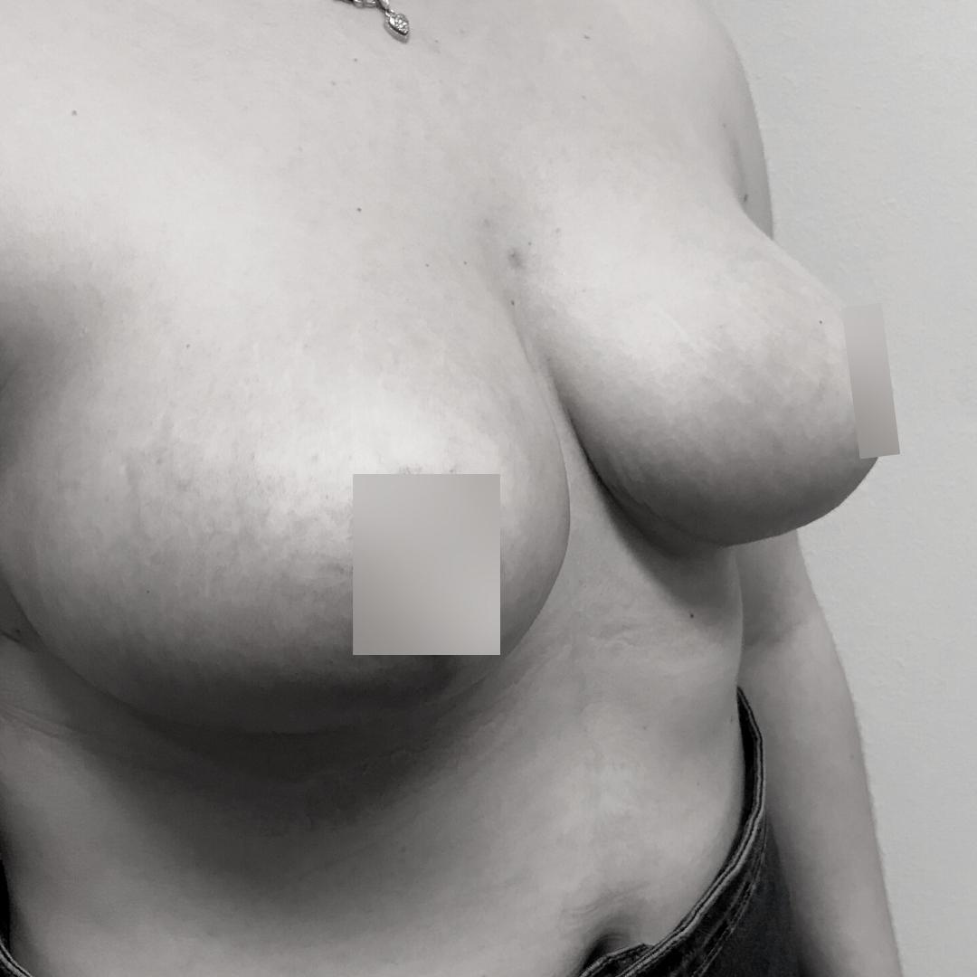 Στήθος - Ανόρθωση 10Β
