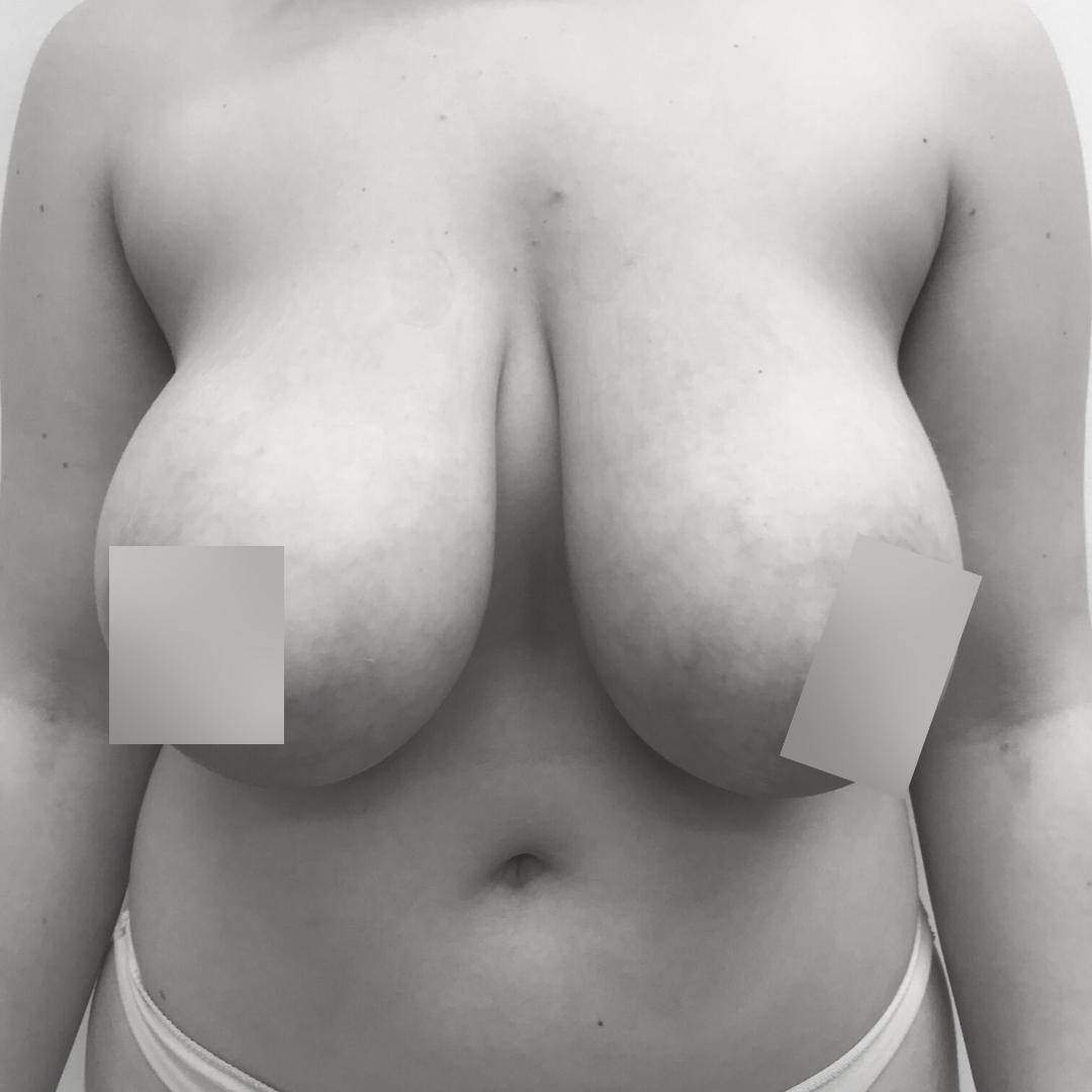 Στήθος - Ανόρθωση 11Α