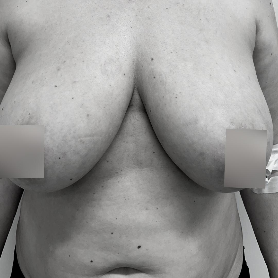 Στήθος - Ανόρθωση 14Α