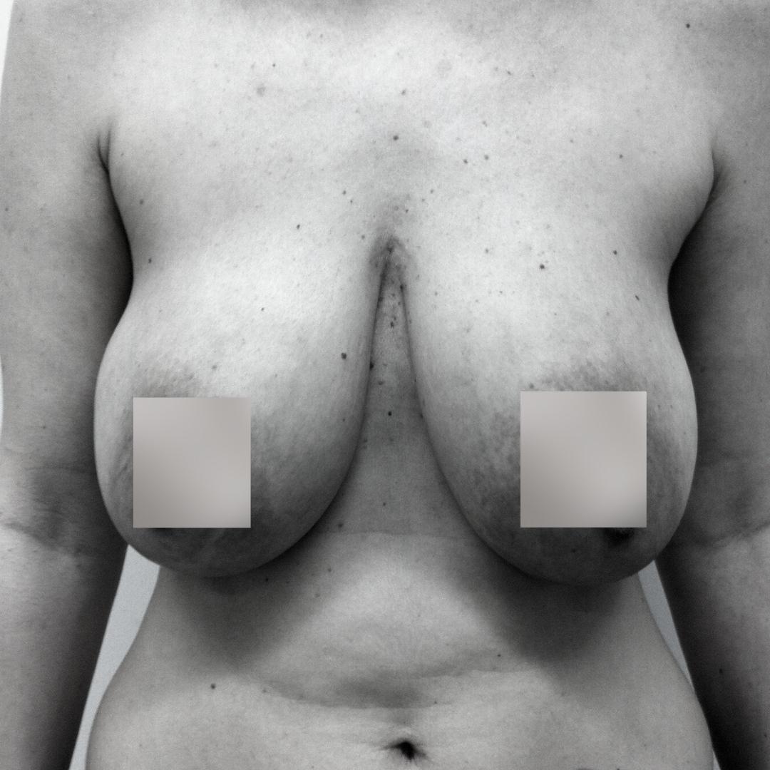 Στήθος - Ανόρθωση 1Α