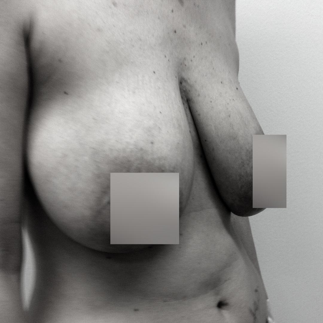 Στήθος - Ανόρθωση 2Α