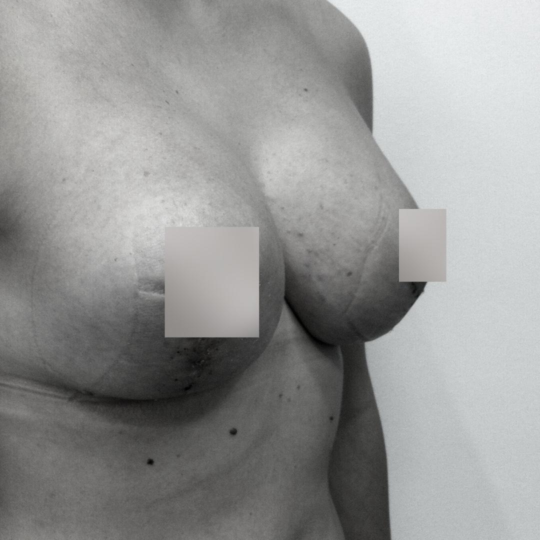 Στήθος - Ανόρθωση 2Β