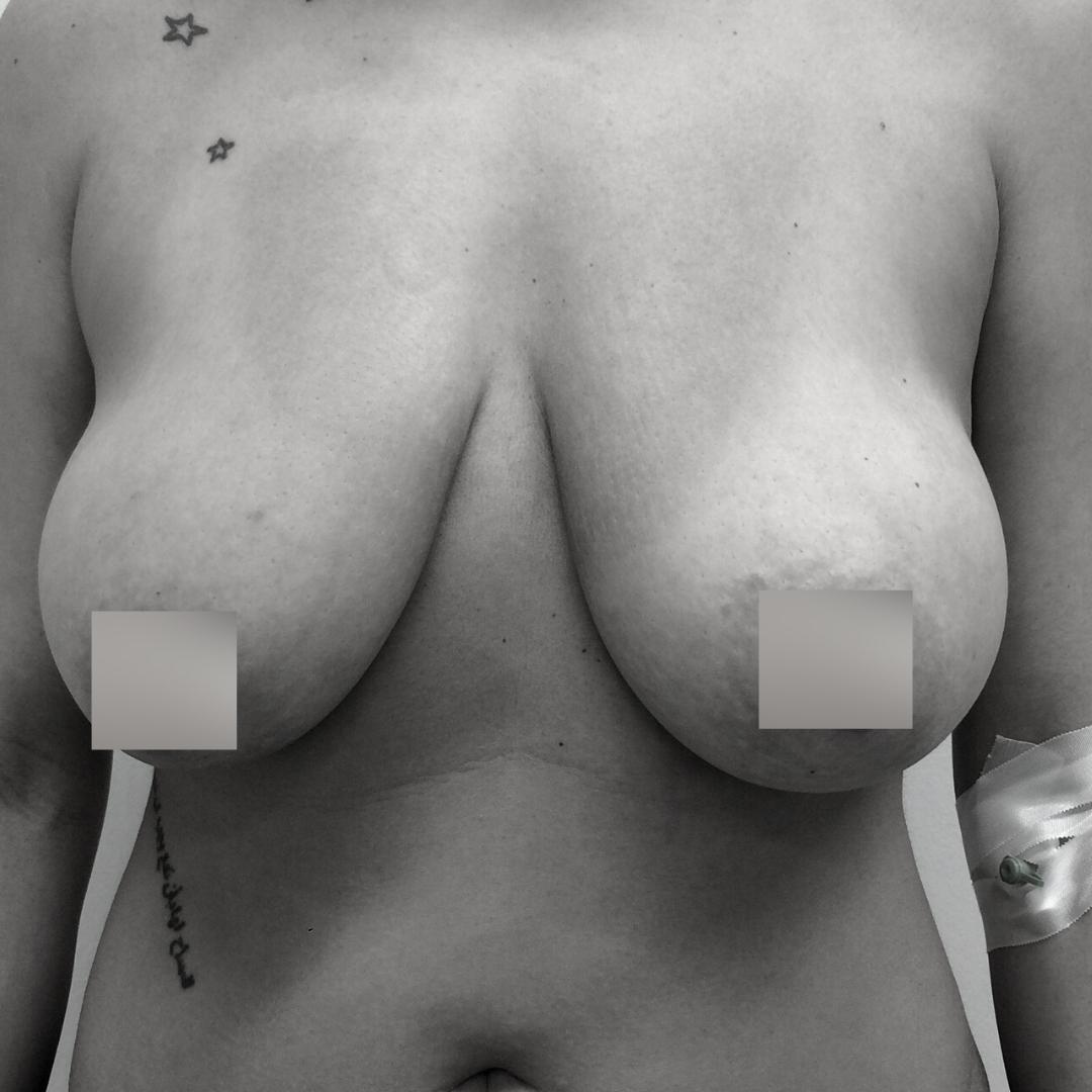 Στήθος - Ανόρθωση 3Α