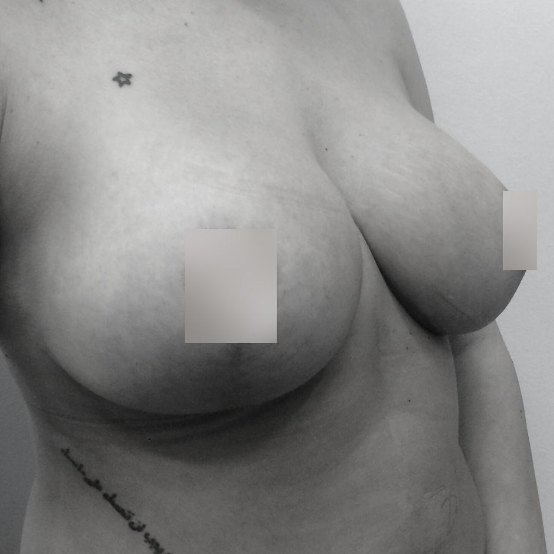 Στήθος - Ανόρθωση 4Β 1