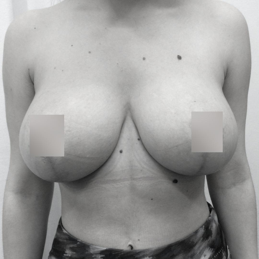 Στήθος - Ανόρθωση 5Β