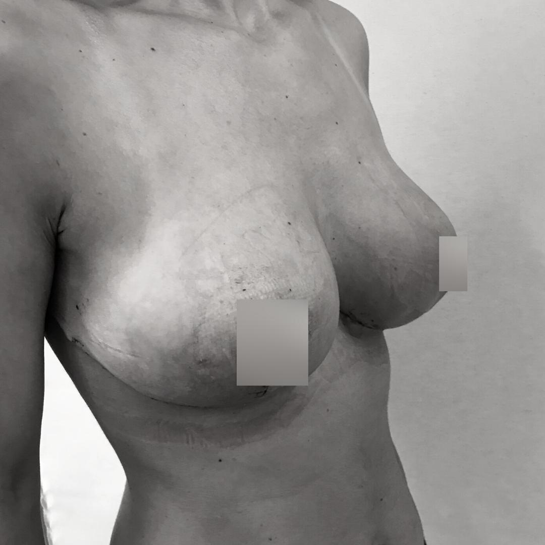 Στήθος - Ανόρθωση 7Β