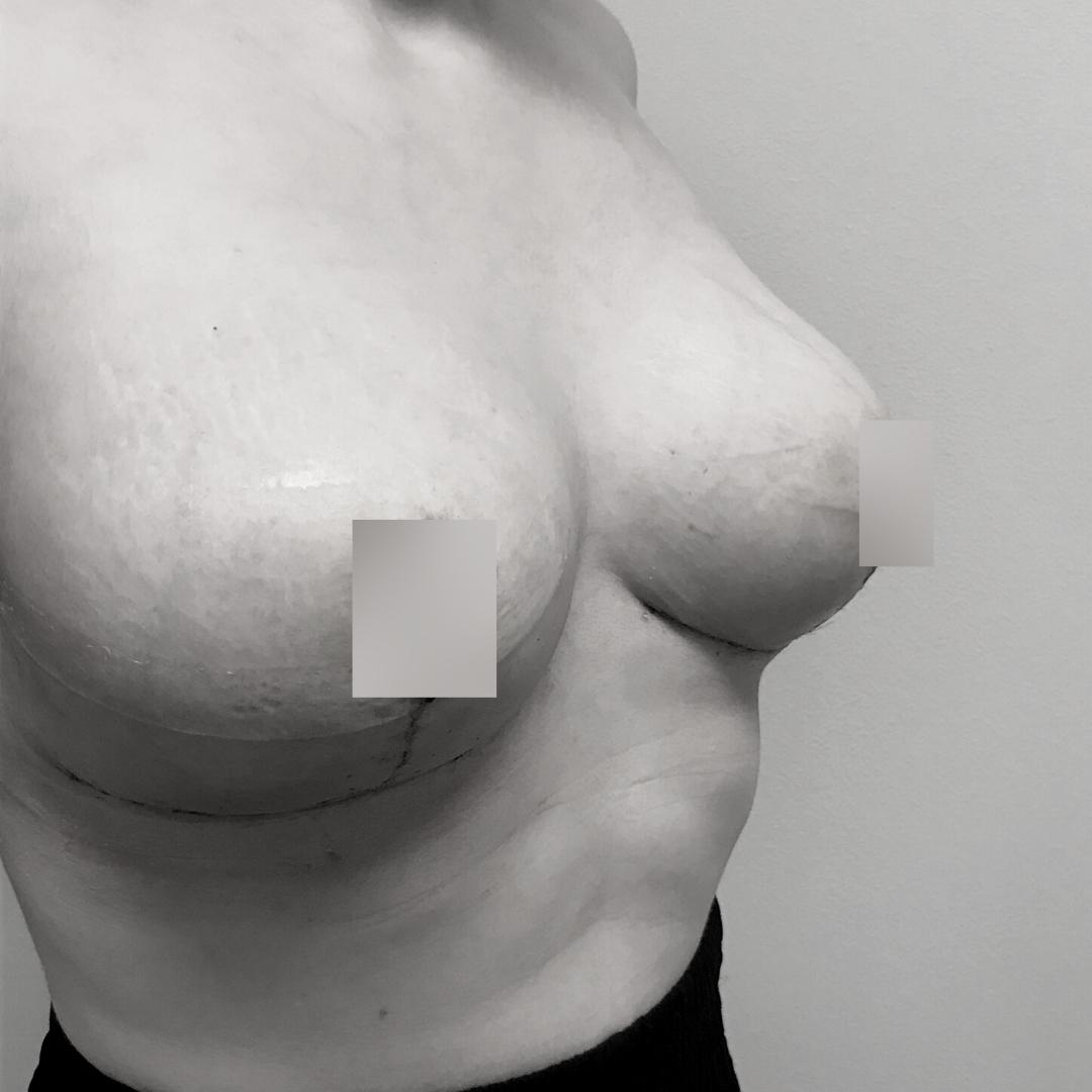 Στήθος - Ανόρθωση 9Β