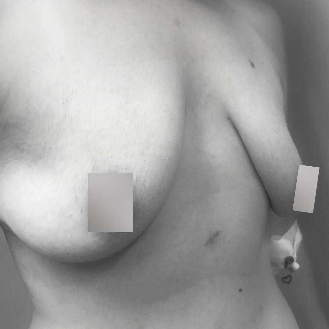 Στήθος - Ανόρθωση επέμβαση 10Γ