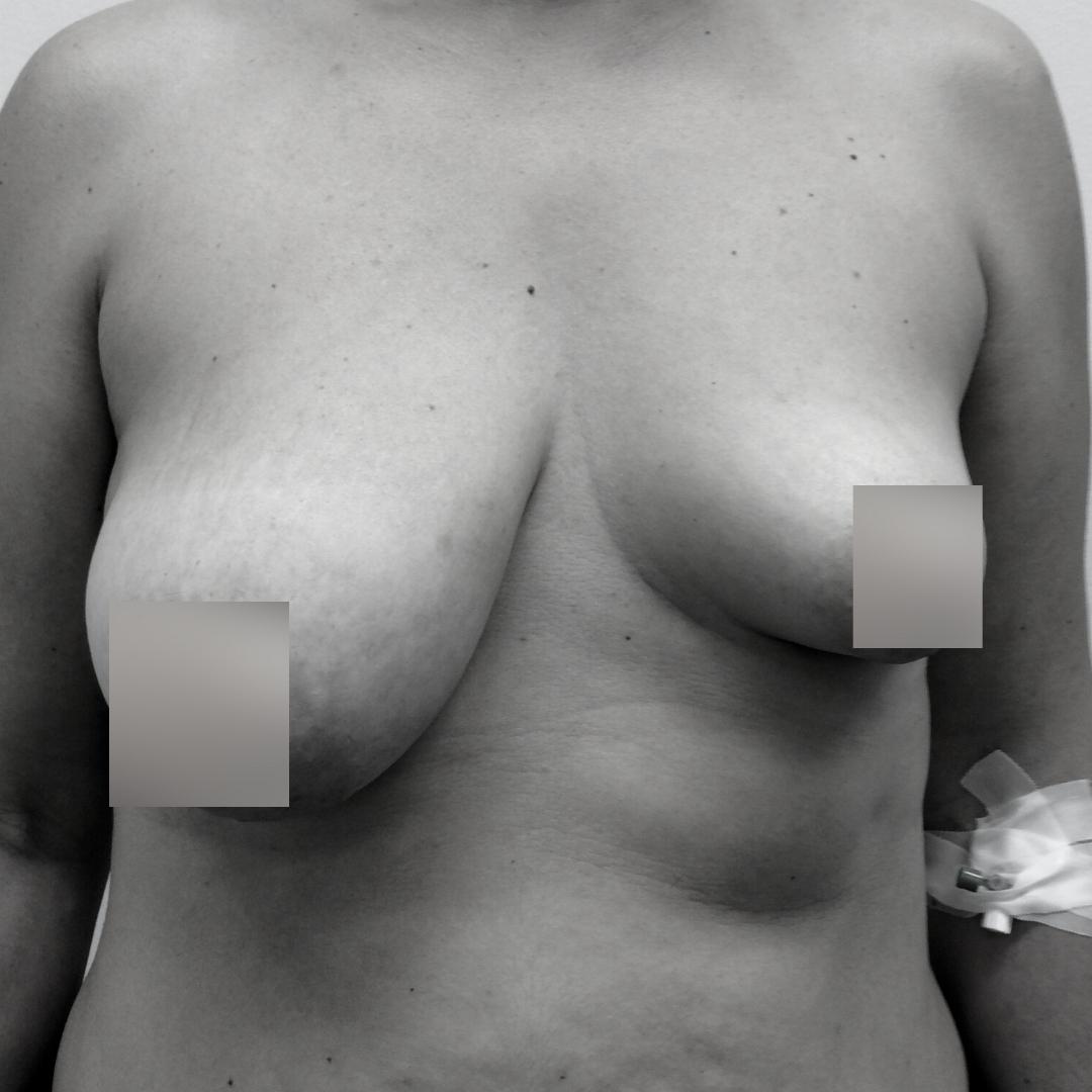 Αυξητική στήθους - Ανόρθωση επέμβαση 11B