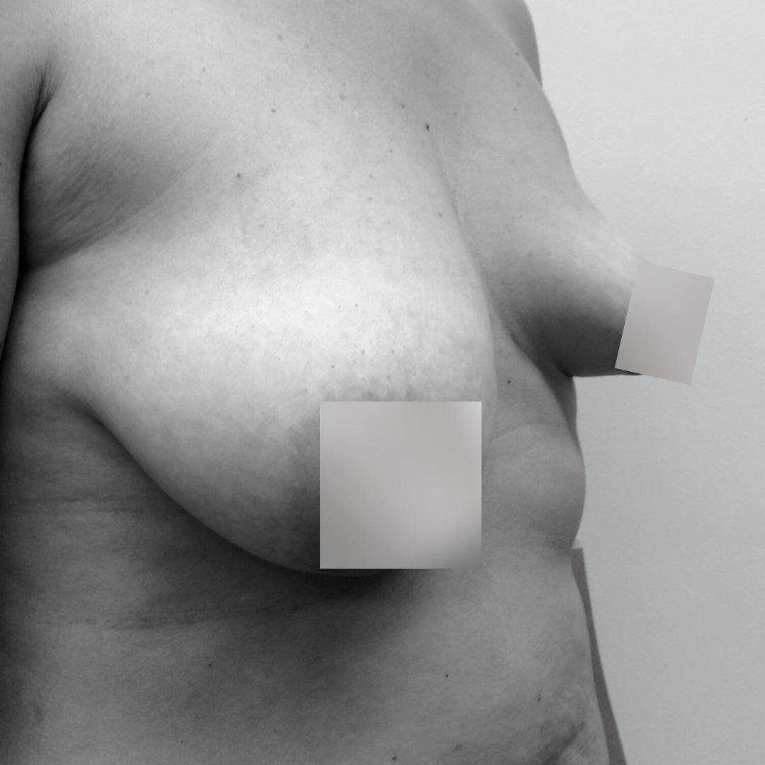 Στήθος - Ανόρθωση επέμβαση 11Δ