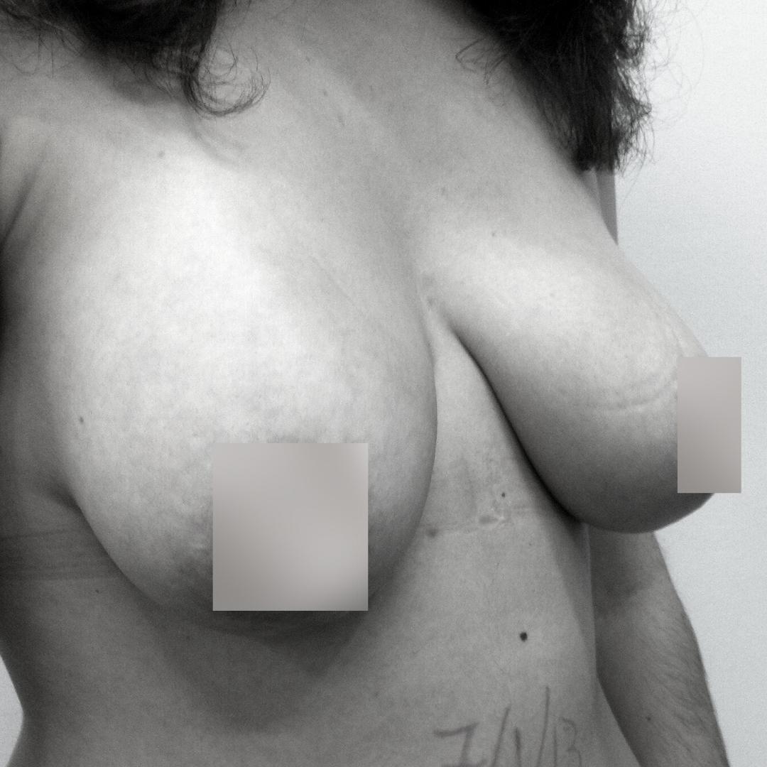 Στήθος - Ανόρθωση επέμβαση 12Α