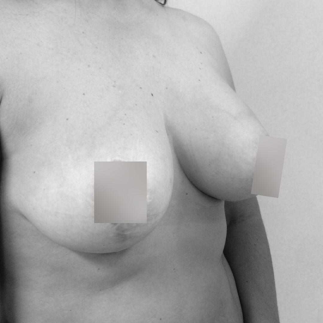 Ανόρθωση στήθους - Αυξητική 13Β