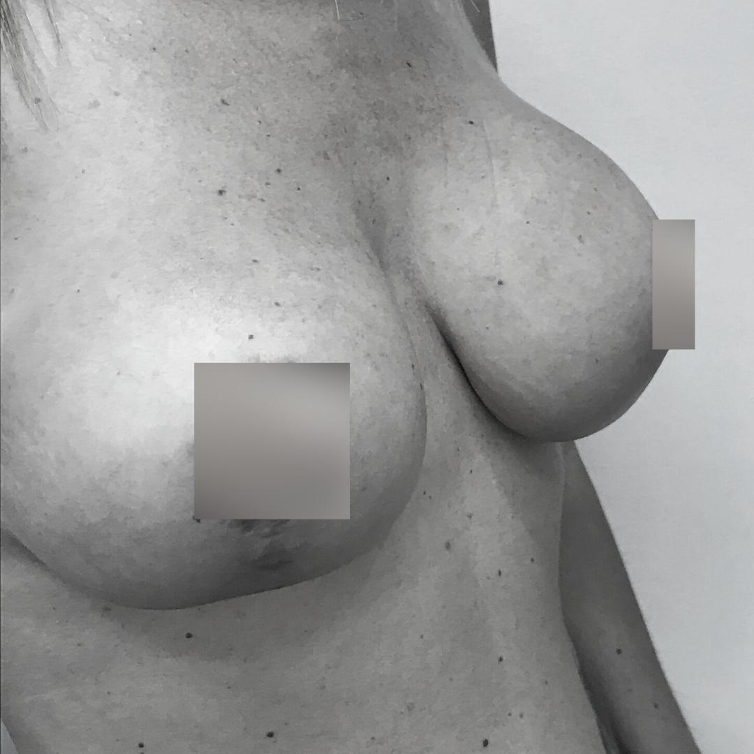 Ανόρθωση στήθους - Αυξητική 4Β