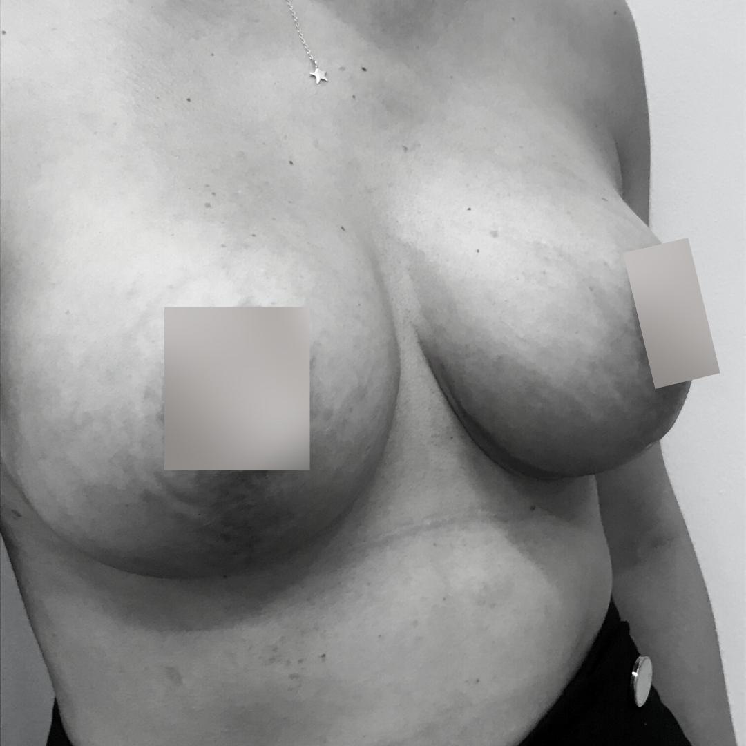 Στήθος - Αυξητική 9Β
