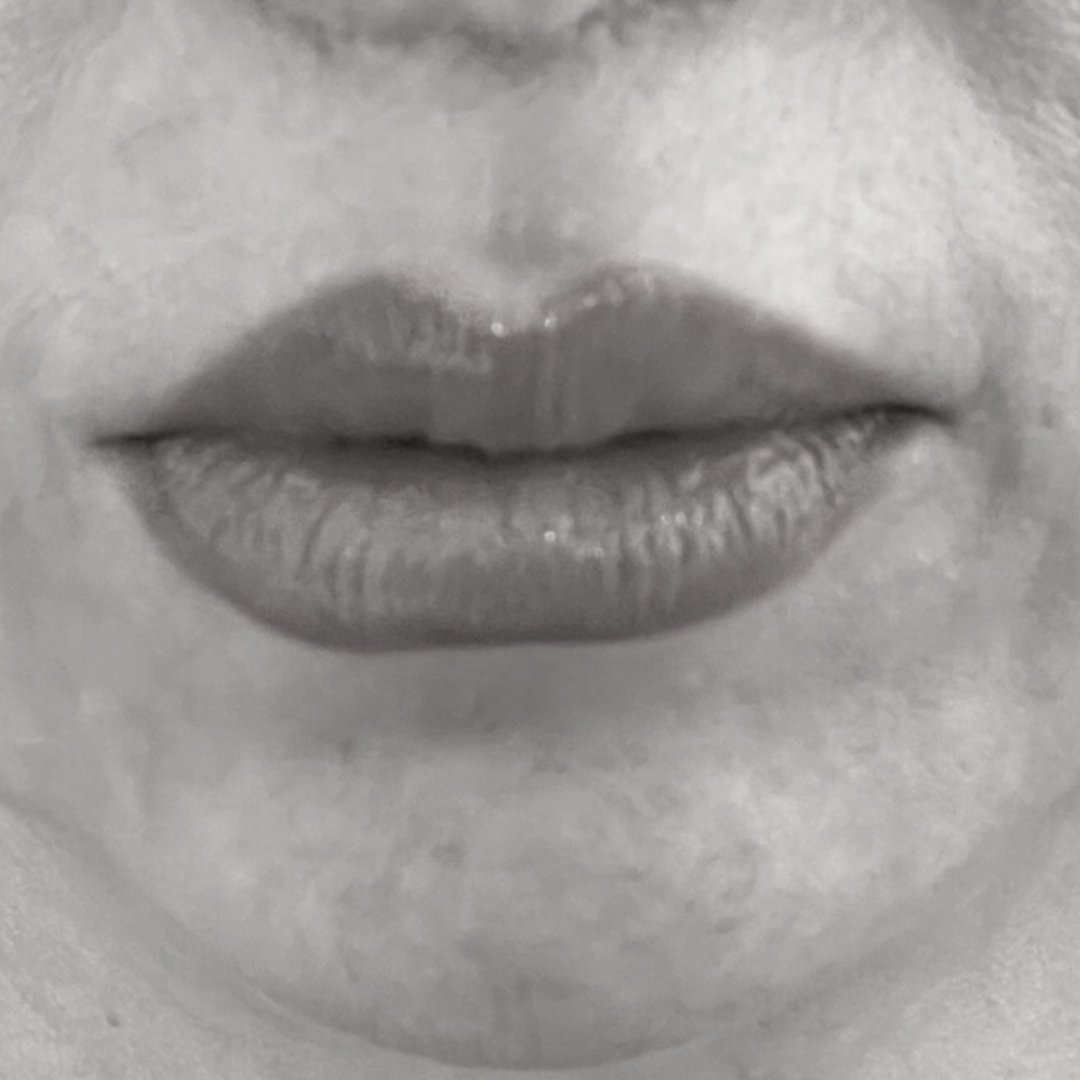 Lifting χείλους - drplastic surgery Liplift 7a
