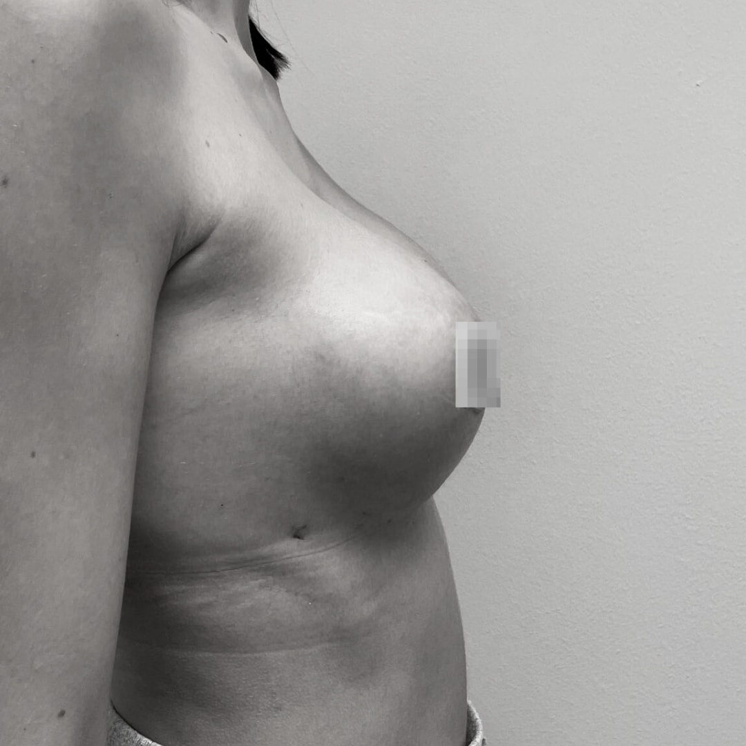 Αυξητική στήθους - drplastic surgery auxitiki stithous 32 after 1