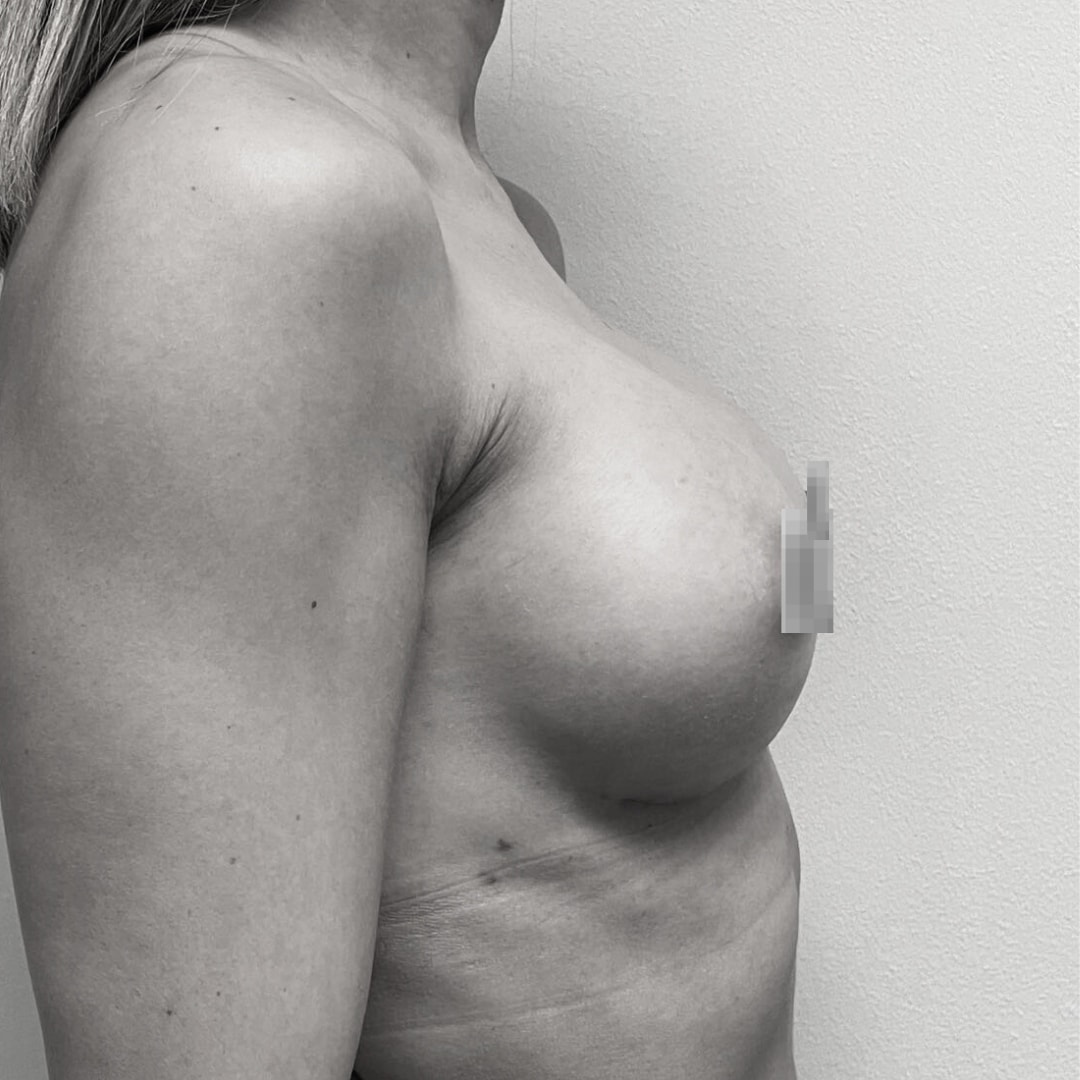 Αυξητική στήθους - drplastic surgery auxitiki stithous 33 after 1