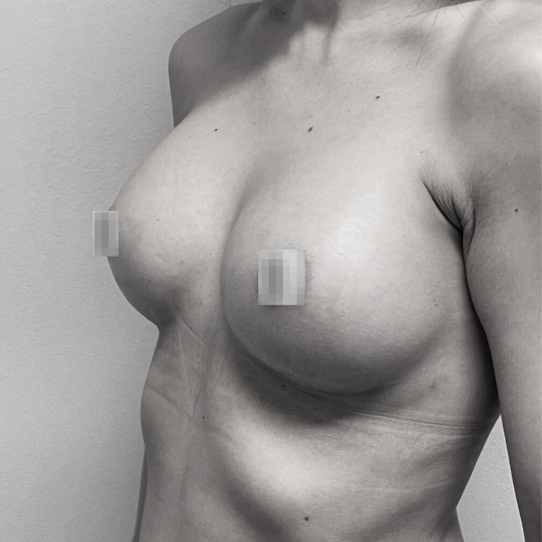 Αυξητική στήθους - drplastic surgery auxitiki stithous 33 after 3
