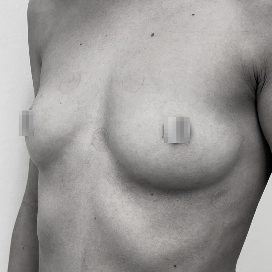 Αυξητική στήθους - drplastic surgery auxitiki stithous 33 before 3
