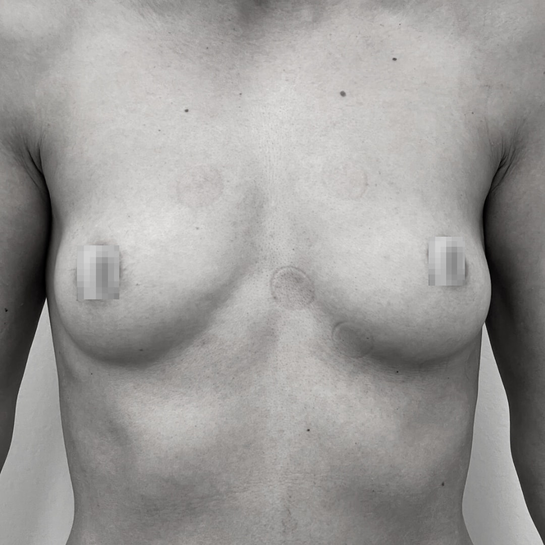 Αυξητική στήθους - drplastic surgery auxitiki stithous 33 before 4