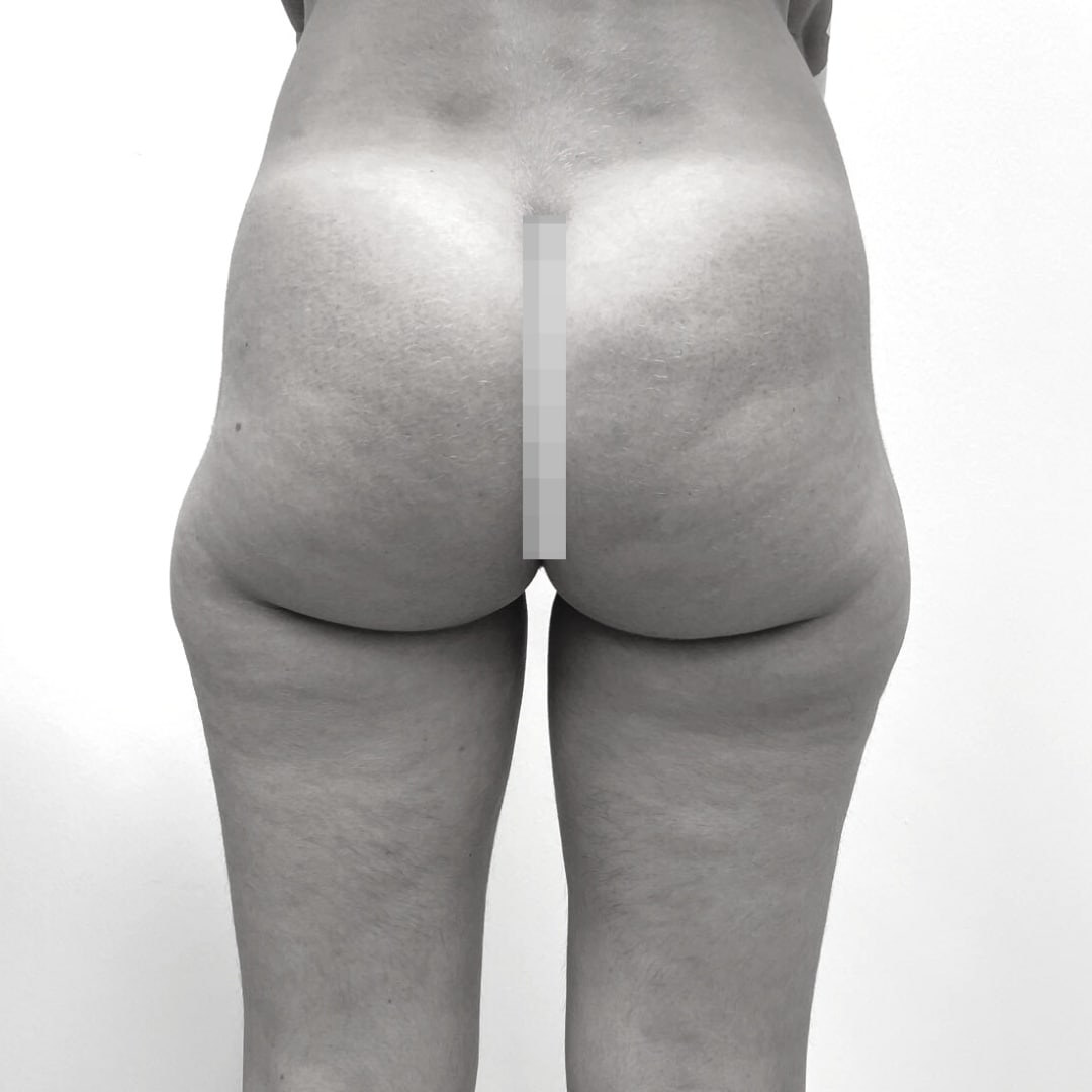 Λιποαναρρόφηση – Λιποανακύκλωση - drplastic surgery liposuction 11 before