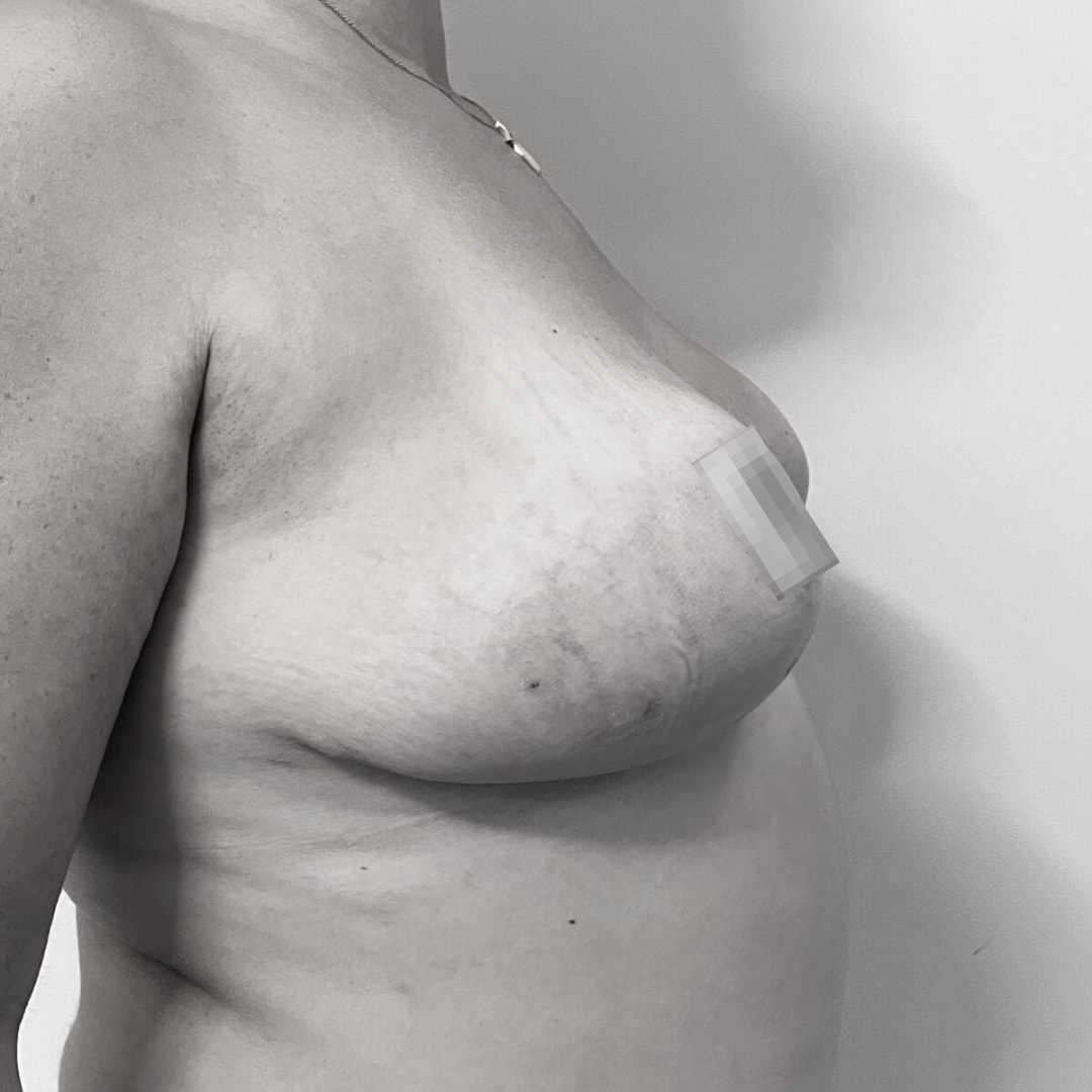 Στήθος - Μειωτική στήθους after 1A
