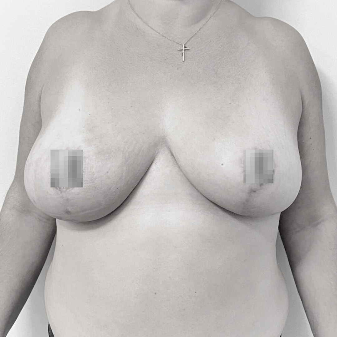 Στήθος - Μειωτική στήθους after 1C