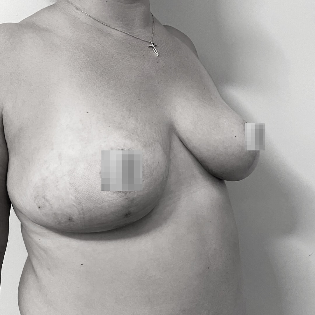 Στήθος - Μειωτική στήθους after 1Β