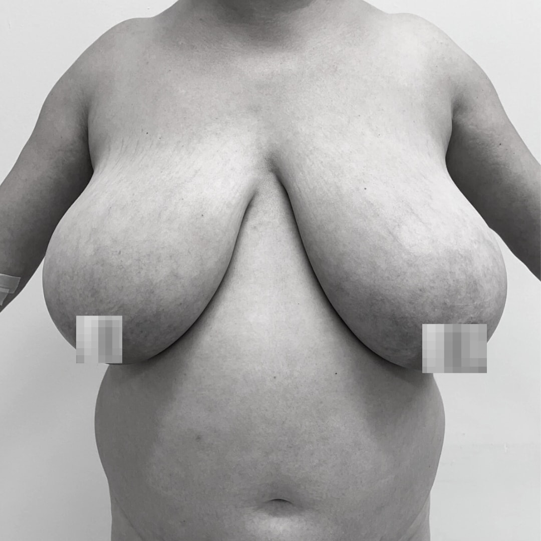 Μείωση στήθους - Μειωτική στήθους before 1C