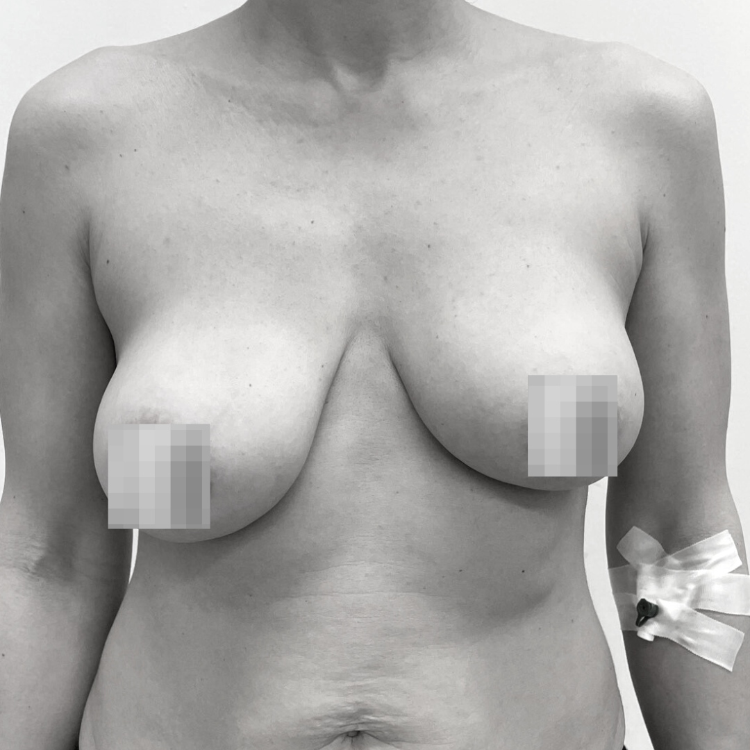 Ανόρθωση στήθους - drplastic anorthosi 16 a b
