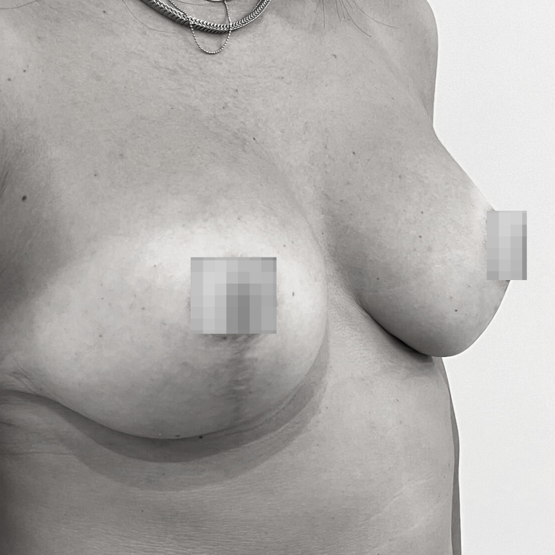 Ανόρθωση στήθους - drplastic anorthosi 16 b a